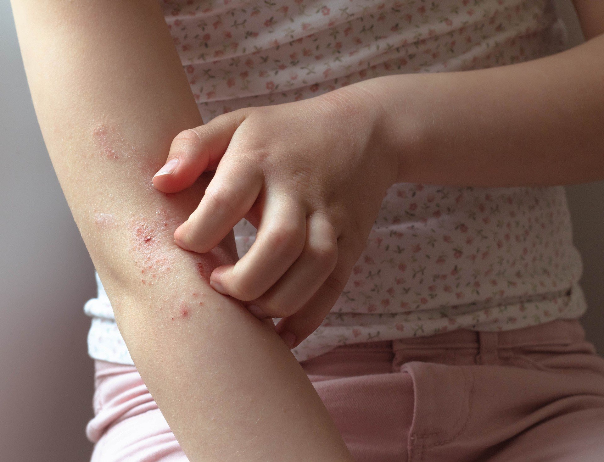 Już wkrótce nowe leki na atopowe zapalenie skóry. Badania kliniczne nad  leczeniem objawów AZS są prowadzone w dwóch miastach Polski | Strona Zdrowia