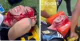 Masakra kibiców Argentyny z policją i Brazylijczykami: głowy we krwi. Infantino potępia, a CONMEBOL umywa ręce