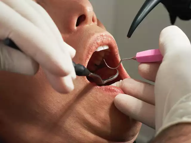 Leczeniem chorób zębów, przyzębia i jamy ustnej zajmują się stomatolodzy. Chorób zębów nie należy lekceważyć, gdyż mogą mieć niebezpieczne następstwa dla całego organizmu.Niektóre usługi dentystyczne przysługują za darmo w ramach Narodowego Funduszu Zdrowia. Co ważne, nie można współpłacić za leczenie czyli częściowo korzystać z usługi NFZ za darmo (np. za leczenie ubytku), a częściowo dopłacić (np. za lepszą plombę). Jeśli pacjent chce mieć wykonaną usługę w wyższym standardzie, musi zapłacić za całość.Sprawdź, do czego masz prawo w ramach NFZ. Takie leczenie przysługuje dorosłym, dzieciom i młodzieży.