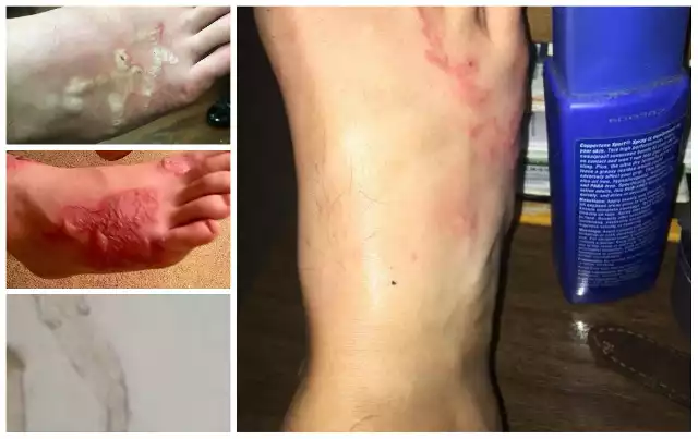 TĘGORYJEC DWUNASTICY - te robaki zainfekowały stopy nastolatka. Jego matka ostrzega: wszystko przez niewinną zabawę na plaży