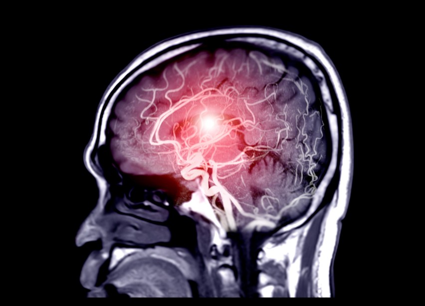 Bóle głowy lub zaburzenia widzeniu mogą być objawem tętniaka...