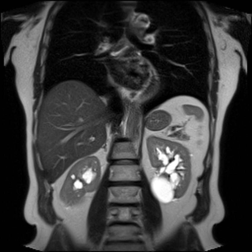 Widok torbieli w lewej nerce w obrazie uzyskanym metodą...