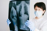 Wraca zapomniana choroba. Lekarze zauważają coraz więcej przypadków gruźlicy w Wielkopolsce