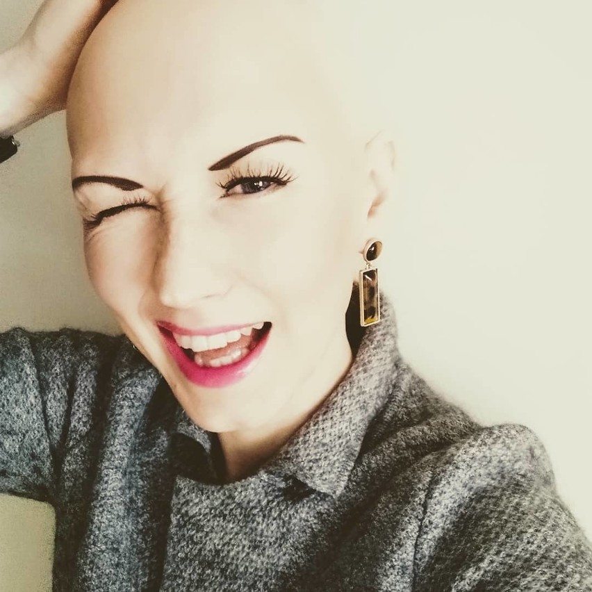 Magdalena Schatt-Skotak cierpi na alopecję, czyli łysienie...