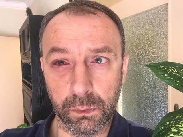Marek Cebula ma uszkodzony wzrok. Przedłużono mu zwolnienie lekarskie.
