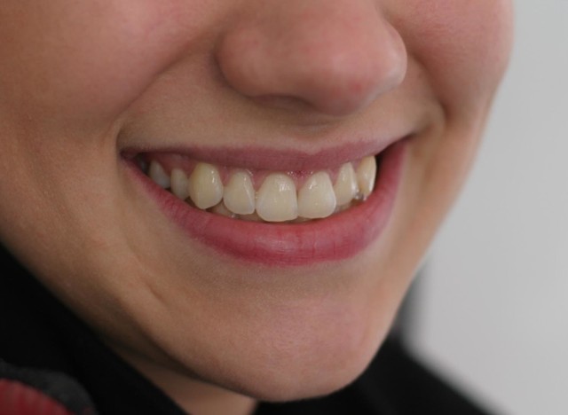 Na zębach odkłada się tylko 20 proc. wszystkich bakterii obecnych w jamie ustnej. Reszta znajduje się na błonach śluzowych i języku. Szczotkując zęby usuwamy bakterie tylko z ich powierzchni. 