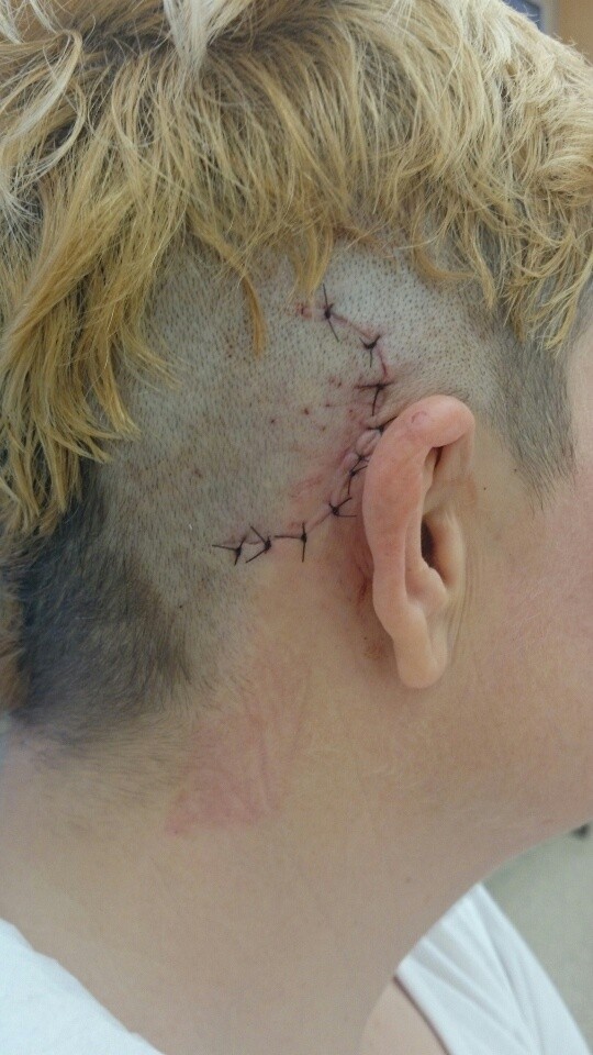 Chirurdzy z Konina wszczepili implanty słuchowe... pod skórę pacjenta