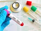 HIV i AIDS – czym się różnią? Jakie są objawy HIV, kiedy wykonać test i na czym polega leczenie zakażenia wirusem HIV?