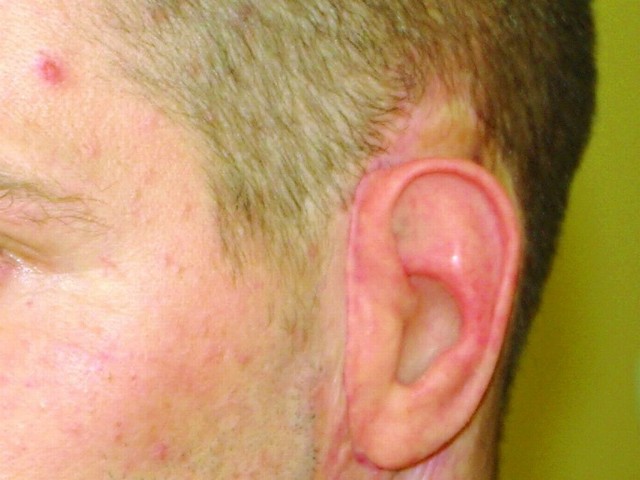 Tak wygląda ucho po zabiegu wszczepienia implantu i protezy.