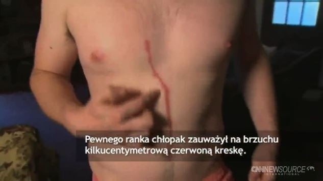 Makabra! Pająk wędrował pod skórą turysty przez 3 dni [SZOKUJĄCE WIDEO]