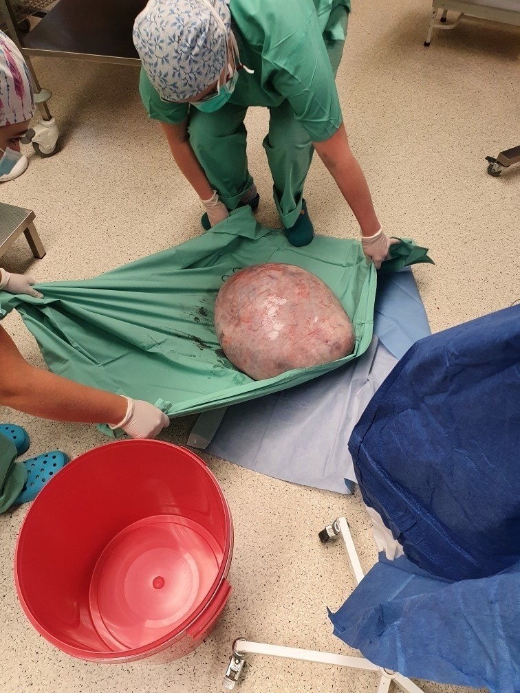 Lekarze usunęli 25-latce gigantycznego guza jajnika.