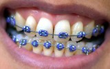 Aparaty ortodontyczne DIY - niebezpieczny trend wśród dzieci i młodzieży!