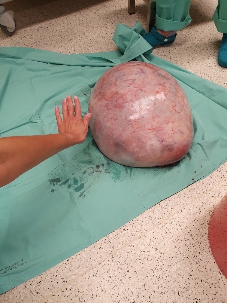 Lekarze usunęli 25-latce gigantycznego guza jajnika.