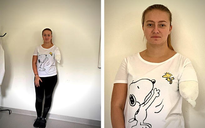 Trwa zbiórka dla Amelii Kropiwnickiej. Ostrowianka straciła rękę w wyniku wypadku, teraz zbiera na protezę