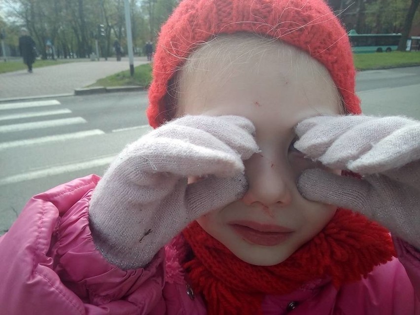 Sosnowiec: lód z ciężarówki ranił twarz 5-letniej dziewczynki ZDJĘCIA