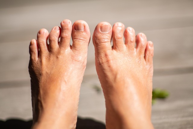 Palce młotkowate to palce stóp, które zakrzywiają się i wywijają pod spód.