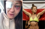 Karolina Kowalkiewicz w walce UFC doznała poważnego urazu oka. Łódzka zawodniczka MMA boi się, że straci wzrok