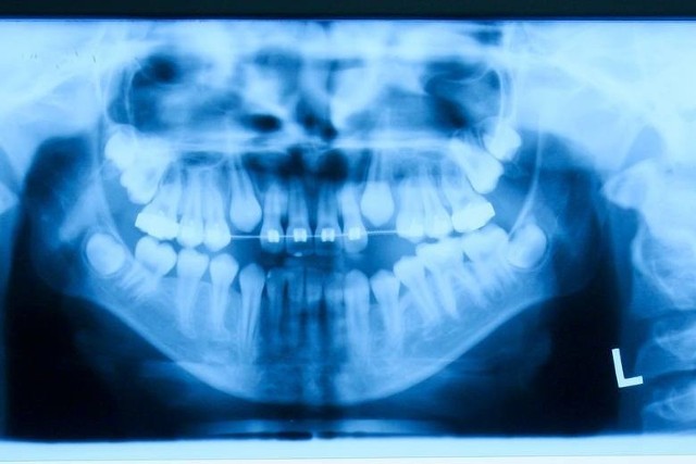 Zakładał aparaty ortodontyczne w promocji, a potem znikał - skarżą się pacjentki. Dzięki publikacjom "Nowościom" jedna z nich - Paulina Tomczykowska z Torunia - dostanie zwrot pieniędzy od przychodni na Skarpie.WIĘCEJ SZCZEGÓŁÓW NA KOLEJNYCH STRONACH >>>>>O sprawie pisaliśmy m.in. tutaj: Uwaga na tego ortodontę! Zakłada "aparat w promocji" i znika
