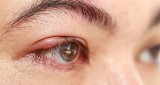 Gradówka jako choroba oczu. Czym się różni gradówka od jęczmienia?