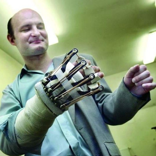 Leszek Opoka, pierwszy pacjent w Polsce, któremu przyszyto rękę pobraną od zmarłego dawcy. Pionierską operację wykonano w Trzebnicy, w czerwcu ub. roku
