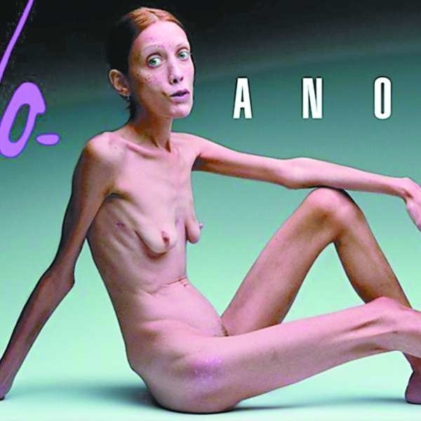 Plakat kampanii przeciwko anoreksji. Problem w tym, że anorektyczki tak się nie widzą.
