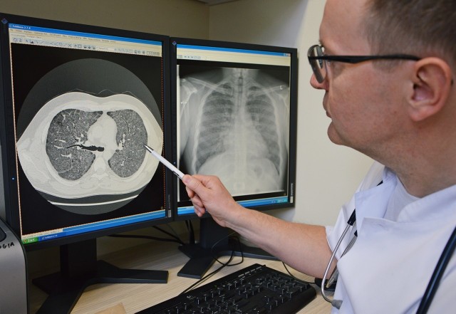 Na zdjęciu z tomografii widać, jak bardzo zniszczone są płuca jednego z mężczyzn. Może go uratować wyłącznie przeszczep.