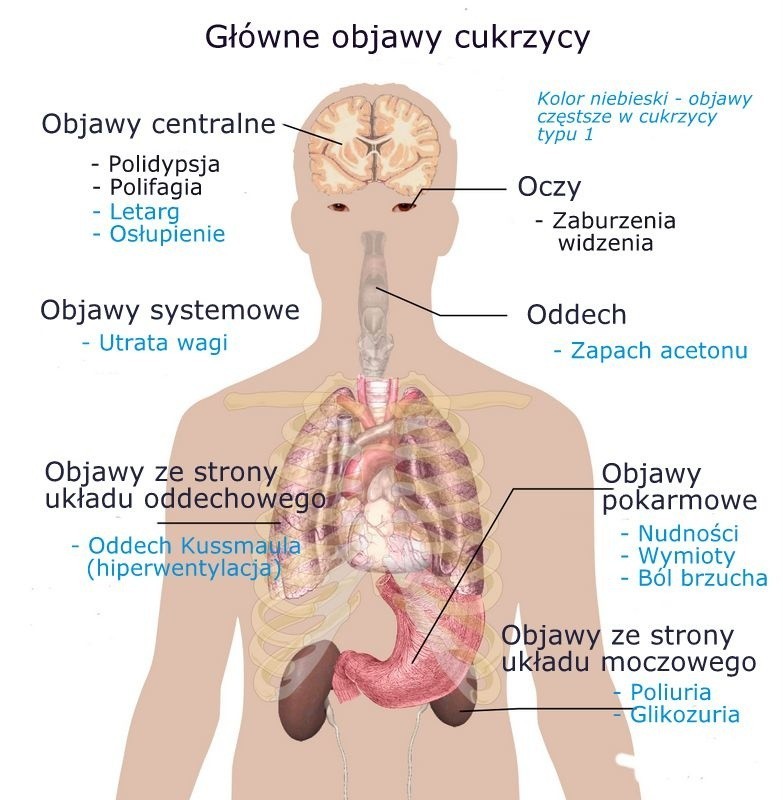 Jakie symptomy mogą wskazywać na to, że grozi nam cukrzyca?