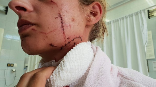 Tak wyglądała poszkodowana niedługo po ataku. Lekarze zdjęli już szwy, ale nie wszystkie rany są całkowicie zagojone