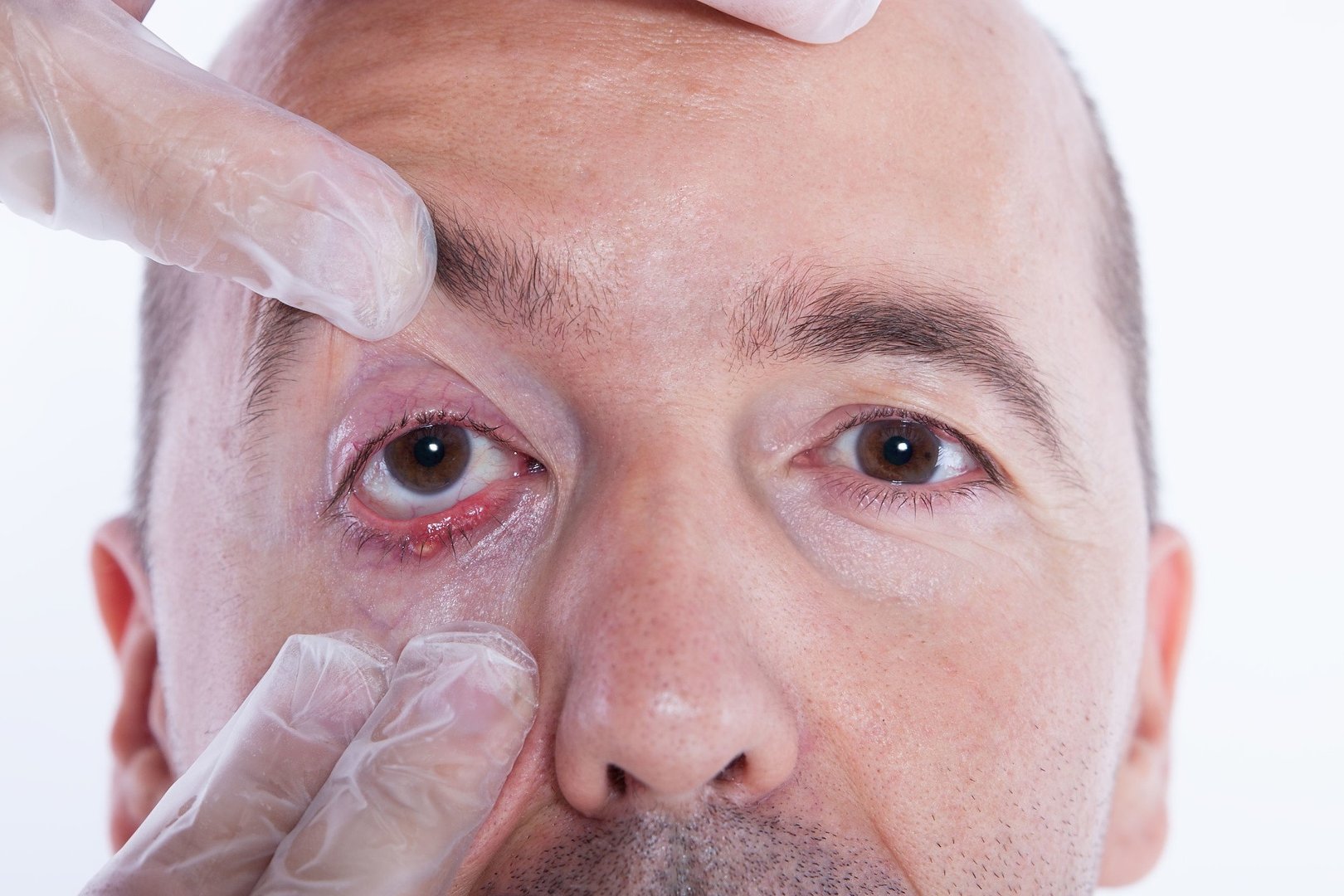 Jak leczyć jęczmień na oku? Od czego robi się jęczmień na powiece i jakie  powoduje objawy? Domowe sposoby na jęczmień | Strona Zdrowia