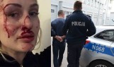 Trener personalny z Gdańska dotkliwie pobił partnerkę. Zamieściła zdjęcia na portalu społecznościowym. Mężczyzna usłyszał zarzut