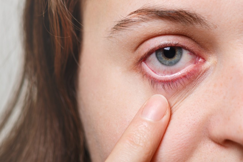 Oczy alergika swędzą i szczypią, więc to naturalne, że masz...