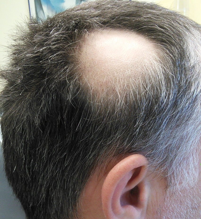 Nadmierne wypadanie włosów – przyczyny i sposoby, by mu zapobiec. Ile włosów  wypada dziennie, a ile świadczy o łysieniu? | Strona Zdrowia
