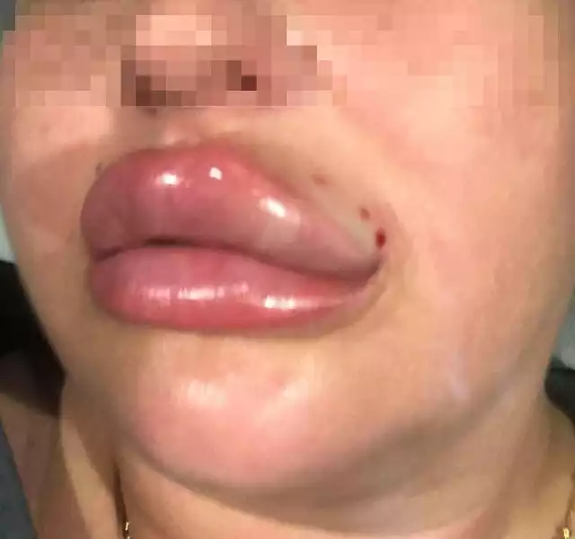 Tak wyglądały usta i twarz pani Laury po zabiegu u kosmetolog z Poznania. Prokuratura wydała już postanowienie o postawieniu kosmetolog zarzutów