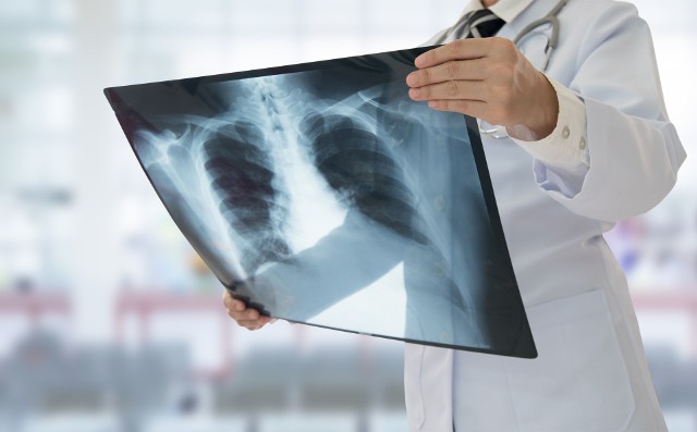 Zdjęcie rentgenowskie klatki piersiowej to podstawowe badanie obrazowe wykorzystywane w diagnostyce chorób układ oddechowego.