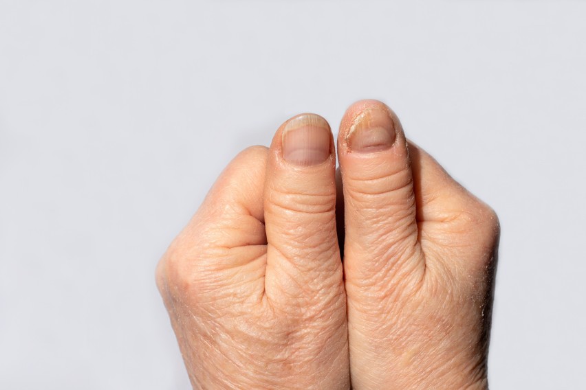 Oddzielanie się płytki paznokciowej (onycholiza), zwykle od...