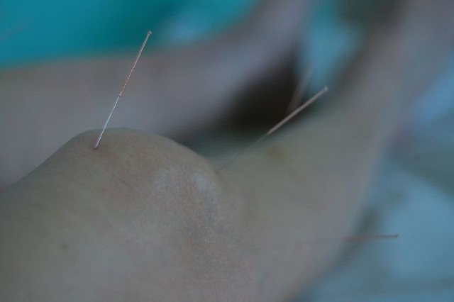 Akupunktura jest zalecana osobom z przewlekłymi dolegliwościami nerwowymi i kostno-stawowymi.