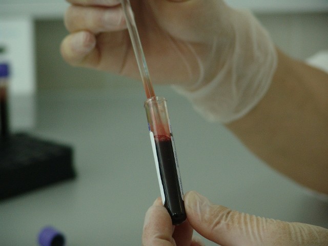 P-LCR (platelet large cell ratio) opisuje konkretnie odsetek dużych płytek krwi (trombocytów).