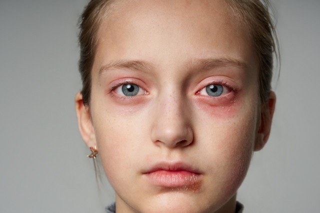 Reakcja alergiczna może obejmować powieki i skórę wokół oczu. Bywa wynikiem uczulenia na alergen kontaktowy, pokarmowy lub wziewny, także z jednoczesnym katarem siennym.