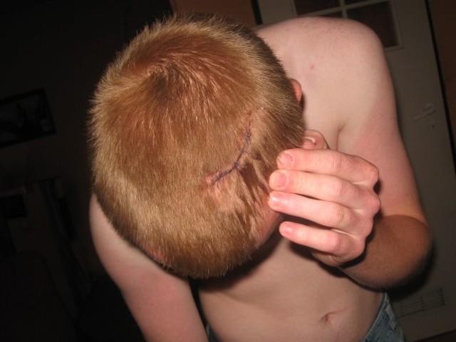 Na głowie jednego z chłopaków widoczna jest rana cięta zszyta przez chirurgów.