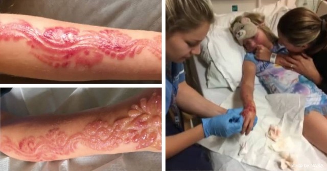 U Madison Gulliver wystąpiły poważne poparzenia. To efekt tatuażu z henny i niebezpiecznego alergenu PPD