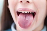 Piecze cię język? Tego objawu nie ignoruj, to może być poważna choroba, którą wykryjesz na czas. Co oznacza szczypiący i piekący język?