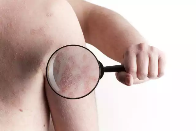 Łupież różowy Gilberta jest stosunkowo rzadką chorobą skóry. Jego główny objaw to wykwit skórny.