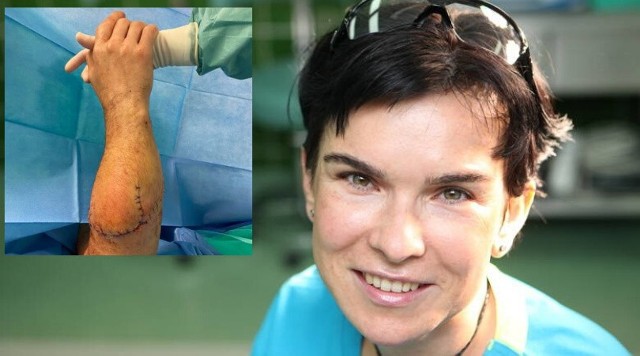 Znana mikrochirurg Anna Chrapusta pochodząca z Limanowej dokonała replantacji odciętej ręki w 5,5 godziny.