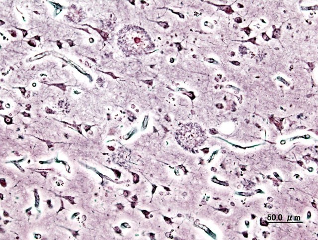 Obraz histopatologiczny płytek starczych w korze mózgu pacjenta z chorobą Alzheimera o początku przed okresem starzenia. Barwienie srebrem