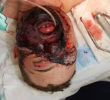 Pierwszy przeszczep twarzy w Polsce: Pomogli naukowcy z Uniwersytetu Śląskiego [ZDJĘCIA 18+]