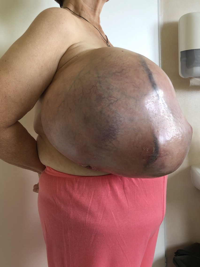 Mieszkanka Jasła przez kilka lat nosiła w piersi 10-kilogramowego guza, bo... bała się operacji. Lekarz: "To ewenement"