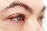 Nużeniec ludzki – jak rozpoznać objawy nużycy? Czym grozi nużeniec w oku? Przyczyny i leczenie pasożytniczej choroby skóry