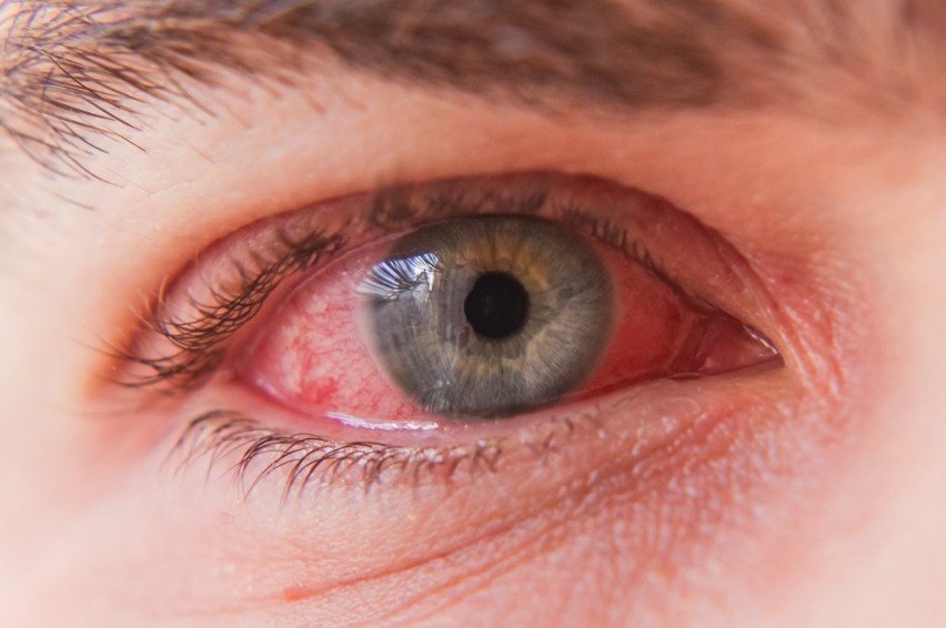 Zmiana zabarwienia białka oka na różowy lub czerwony często...
