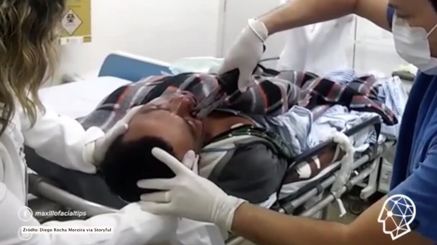 Chirurg usunął nóż wbity w twarz mężczyzny [FILM, drastyczne ujęcia]