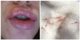 "Druty" w twarzy, ból i twarde usta - dramatyczne efekty powiększania ust u kosmetolog z Poznania. Klientki potem musiał ratować lekarz